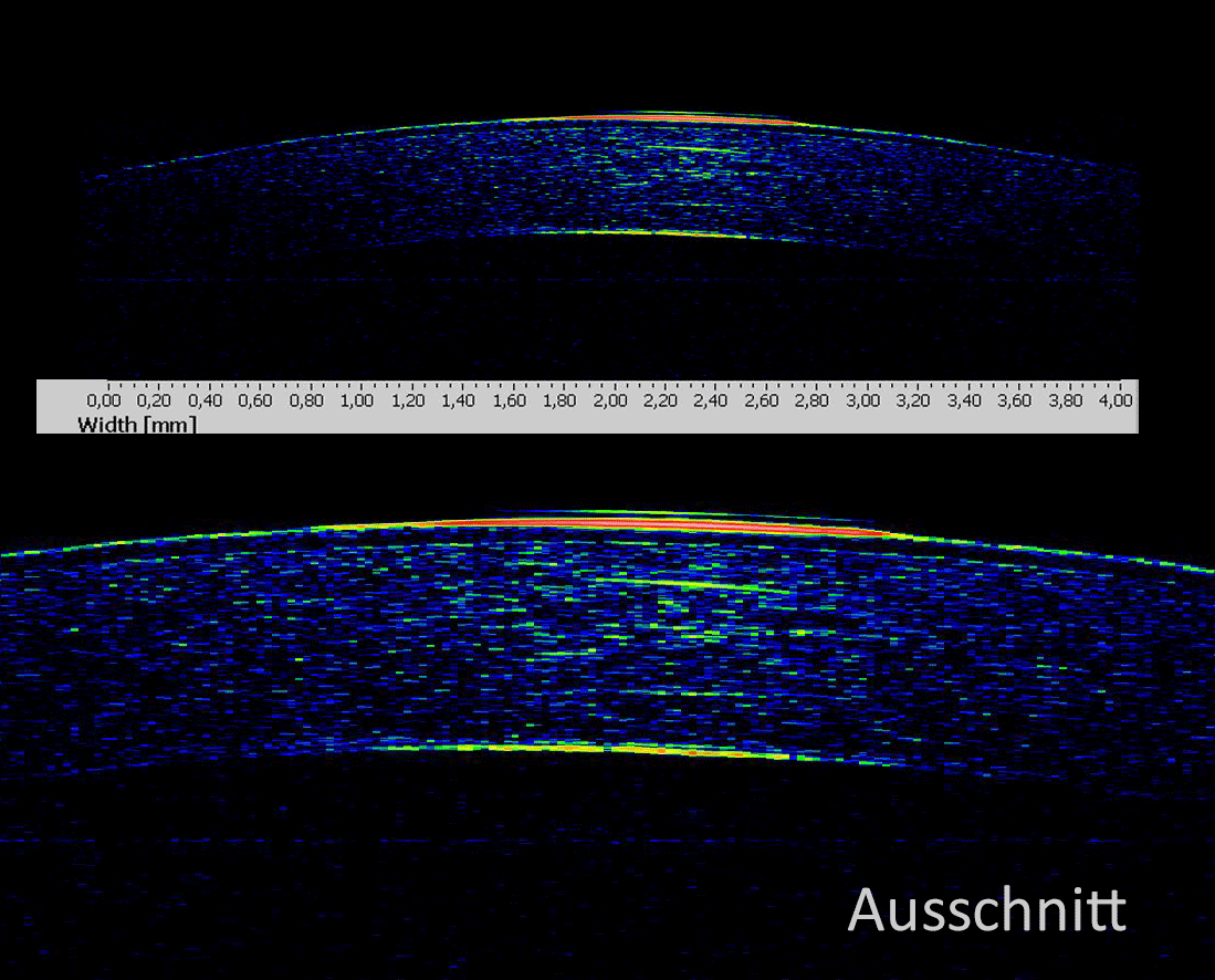 Analyse der Hornhaut des Auges im EVEIT-System mittels Optischer Kohärenztomographie